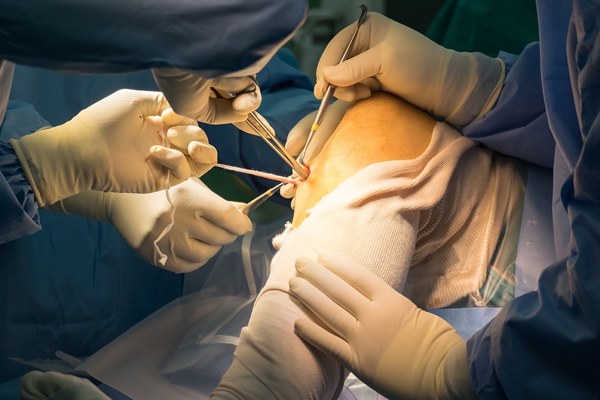 Preparation,Tendon,For,Aclr,(arthroscopic,Acl,Reconstruction)